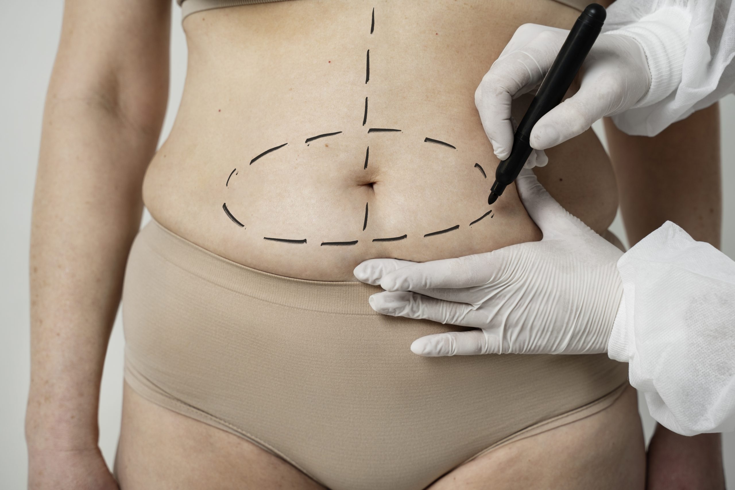 Liposuction vs Weight Loss: Differences, Benefits, and Risks Explained